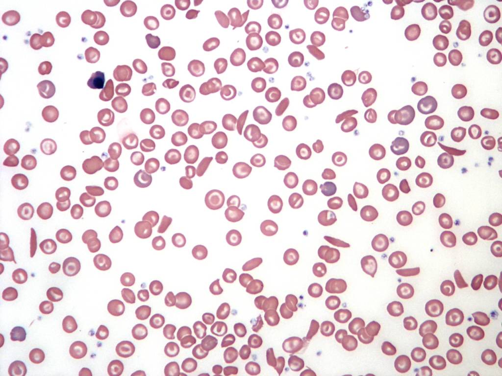 Picture of Sickle Cell Blood Smear
